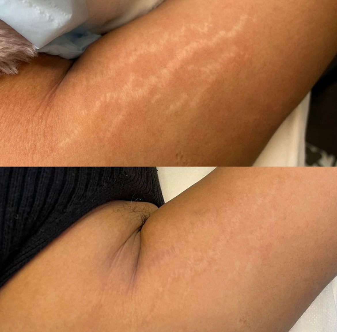 Stretch Mark Oil (Limited Price)