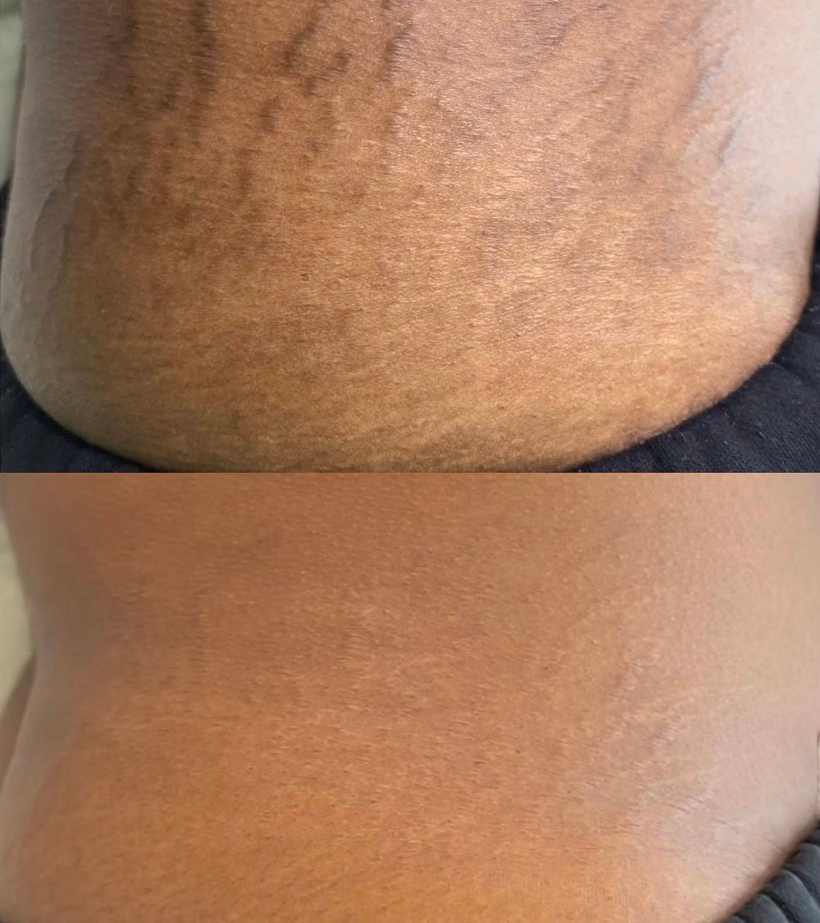 Stretch Mark Oil